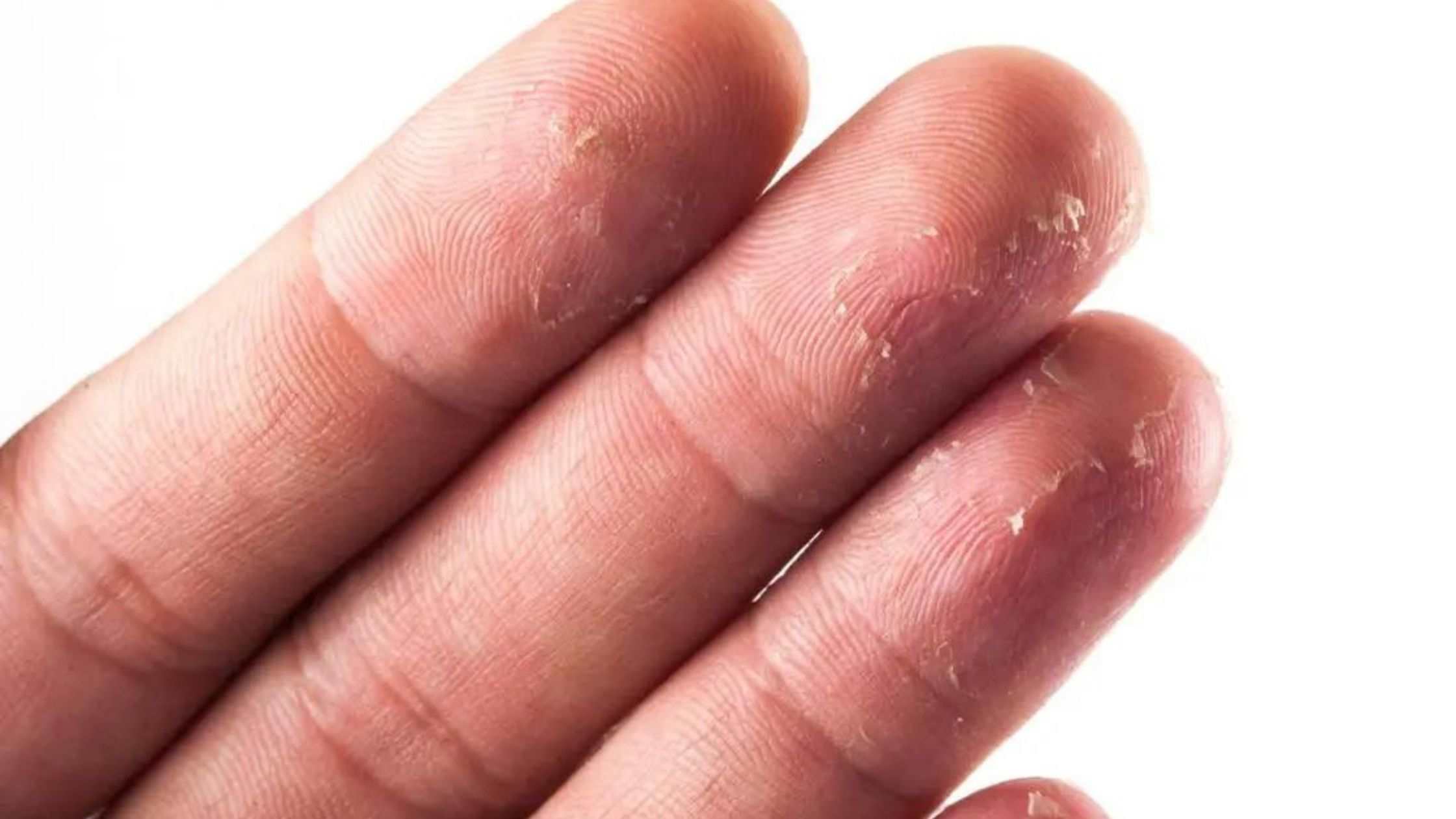 Alergia na gélové nechty
