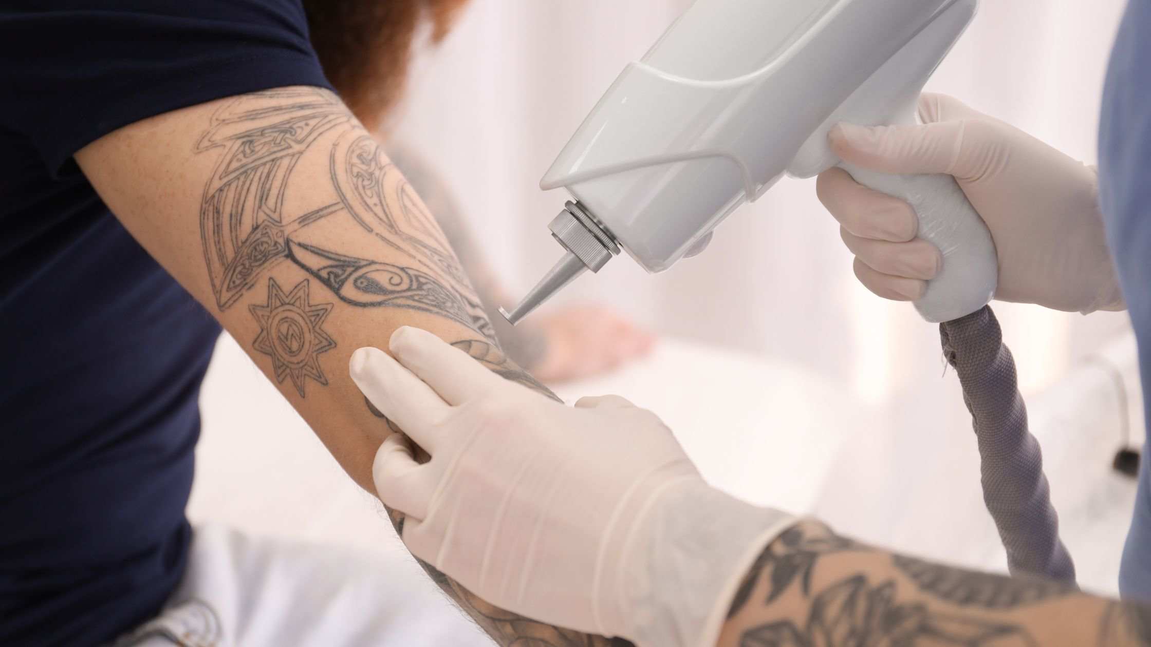 odstránenie tetovania